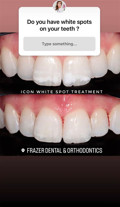 White spots on your teeth? Introducing ICON white spot treatment - Frazer Dental