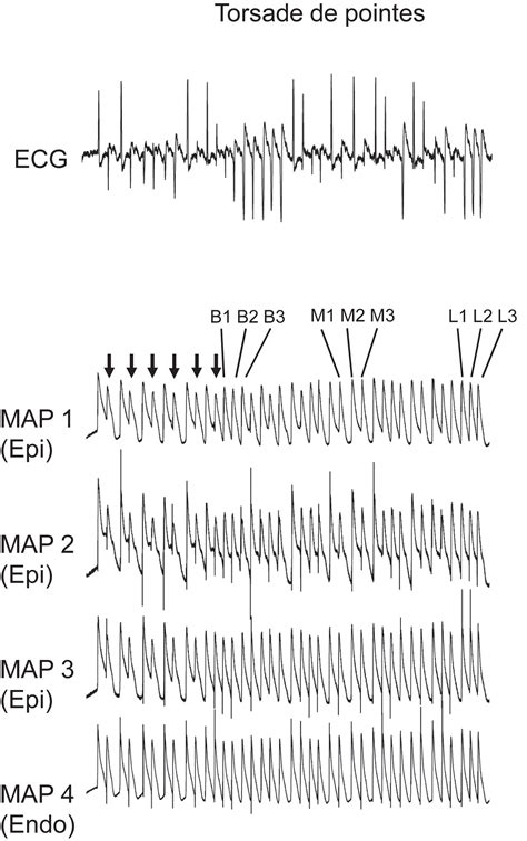 Mechanisms underlying the spontaneous termination of torsades de pointes in an experimental ...