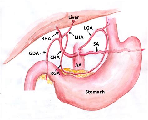 SciELO Brasil - Absence of the celiac trunk and trifurcation of the ...