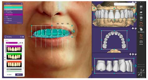 Predictable Full Digital Workflow Using Stackable Surgical Templates ...