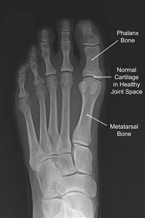 Big Toe Arthritis — Daniel Bohl, MD | Midwest Orthopaedics at RUSH