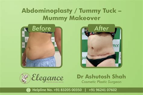 Abdominoplasty, Tummy Tuck Surgery, Mummy Makeover in Udhna, Surat
