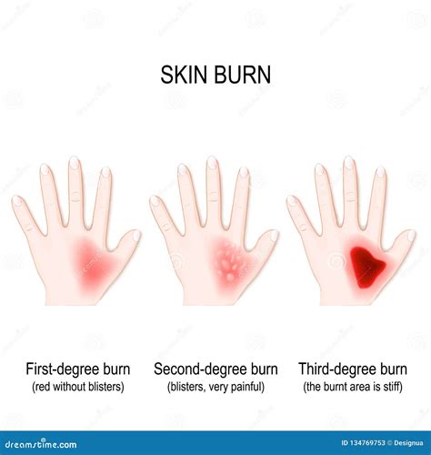 First Degree Burn On Arm