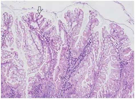 Tubular Adenoma Histology