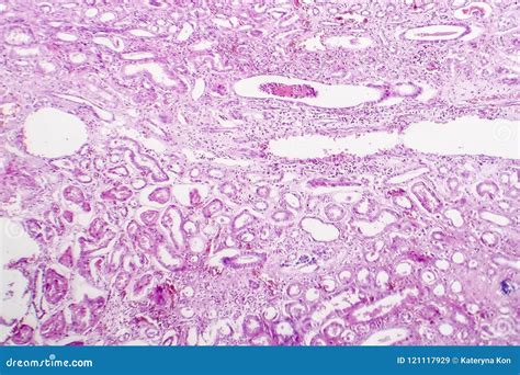 Reinke's Edema Histopathology at Emily Jenkins blog