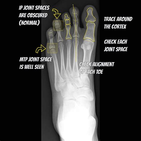 Foot Xray Anatomy