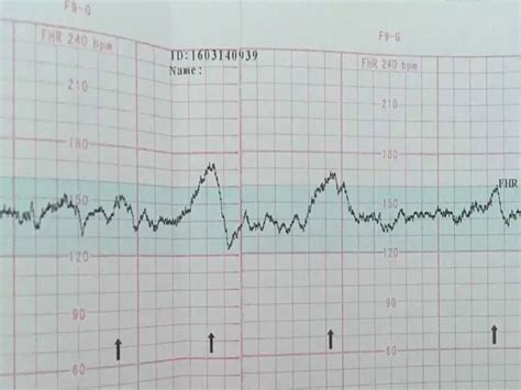 【轻松识别胎儿监护图】【图】教你轻松识别胎儿监护图 在家中监测胎心的三种方法_伊秀亲子|yxlady.com