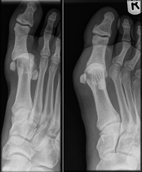 Turf toe injury | Emergency Medicine Journal