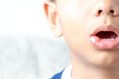 Cold Sore On Lips: Causes, Symptoms and Home Remedies