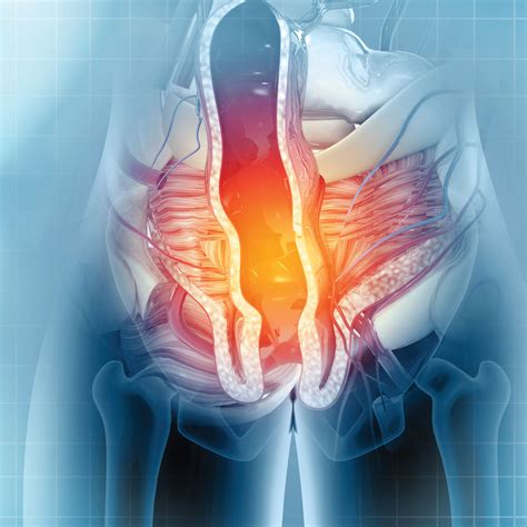 A New Way to Treat Hemorrhoids: What You Need to Know About Hemorrhoidal Artery Embolization ... - what doctor treats hemorrhoids