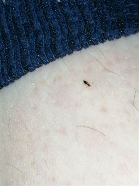 How Long Till Bed Bug Bites Go Away at Regena Rudolph blog