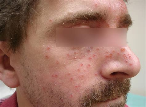 Eczema - Hand, Face, Baby, Causes, Symptoms & Treatment