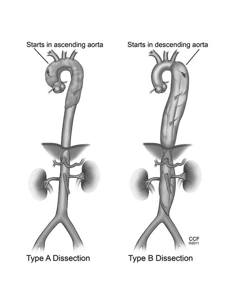 Aortic Dissection | 2016-10-24 | AHC Media:… | Clinician.com