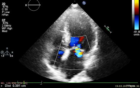 Life Expectancy After Cardiac Ablation