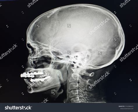 Xray Skull Finding Cranial Vault Intact Stock Photo 1516586423 | Shutterstock