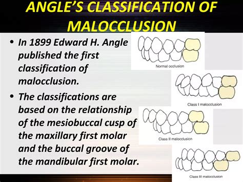 Classification of malocclusion | PPT | Dental Health | Diseases and ...