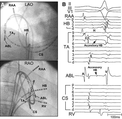 Catheter Ablation of Paroxysmal Supraventricular Tachycardia | Circulation