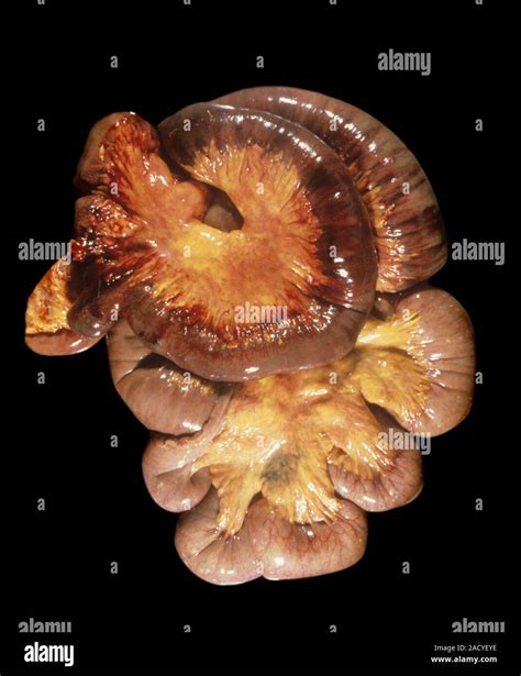 Bowel infarction. Intestines affected by bowel infarction. Infarction is tissue death (necrosis ...