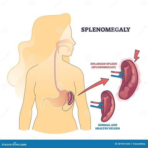 Splenomegaly Symptom As Enlarged Spleen Vs Healthy Organ Outline Diagram Stock Vector ...