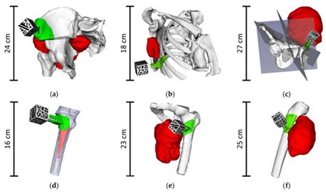 Combining Augmented Reality and 3D Printing to Improve Surgical ...