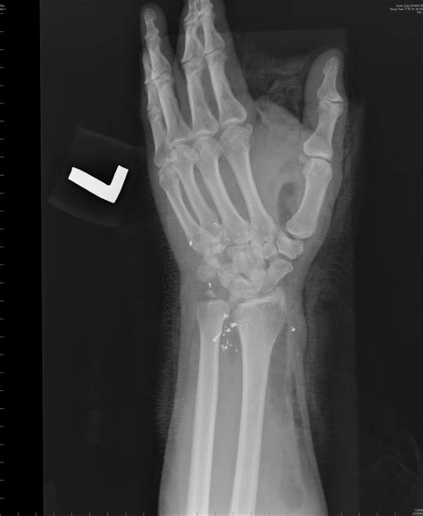 Ulnar Styloid Process Fracture X Ray at Agnes Hendricks blog