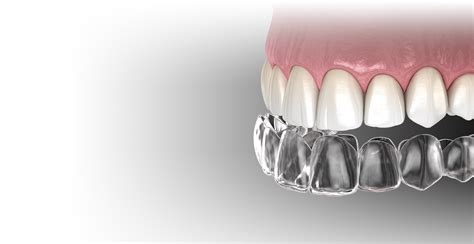 Clear Aligners | Dental Square | Best dentist and dental clinic in Roorkee