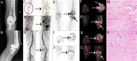 Application of 68Ga-citrate PET/CT for differentiating periprosthetic ...