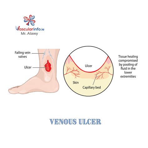Varicose Veins & Venous Diseases - Vascular Info