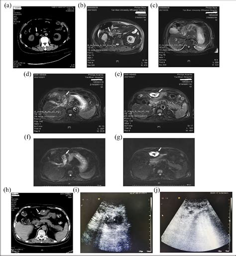 Abscess of ligamentum teres hepatis post-endoscopic retrograde ...