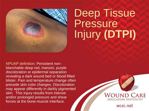 Test Your Pressure Injury Staging Skills - Updated for 2016 | PDF