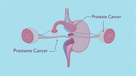 Prostate Cancer - Urology Specialist Clinic in Kuala Lumpur Malaysia