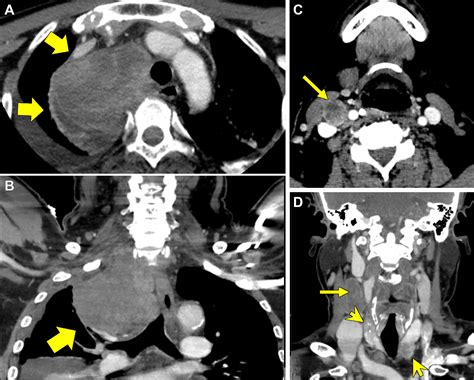 Skip and Mediastinal Metastasis in Papillary Thyroid Cancer | Radiology: Imaging Cancer