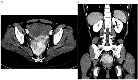 Hyaline and Cystic Degeneration of Uterine Leiomyomas: CT and MR ...