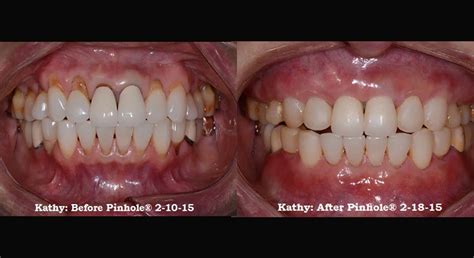 Receding Gums Treatment Gum Recession: Causes, Reversal & Treatment