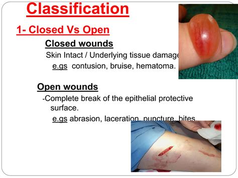 wound and types wound healing and dressing.pptx