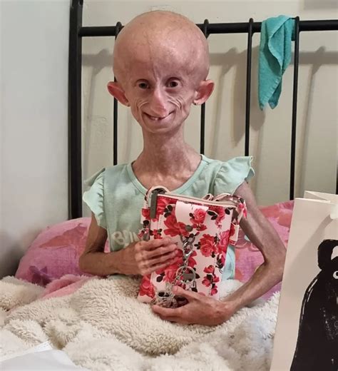 Beloved TikTok Star Beandri Booysen, 19, Dies After Rare Disorder ...
