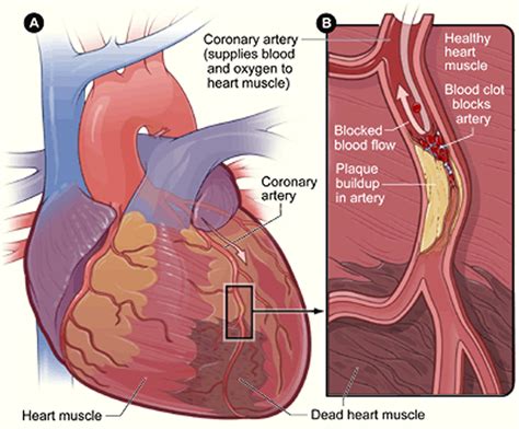 How To Differentiate Between Pain in the Esophagus & Heart Attack Pain