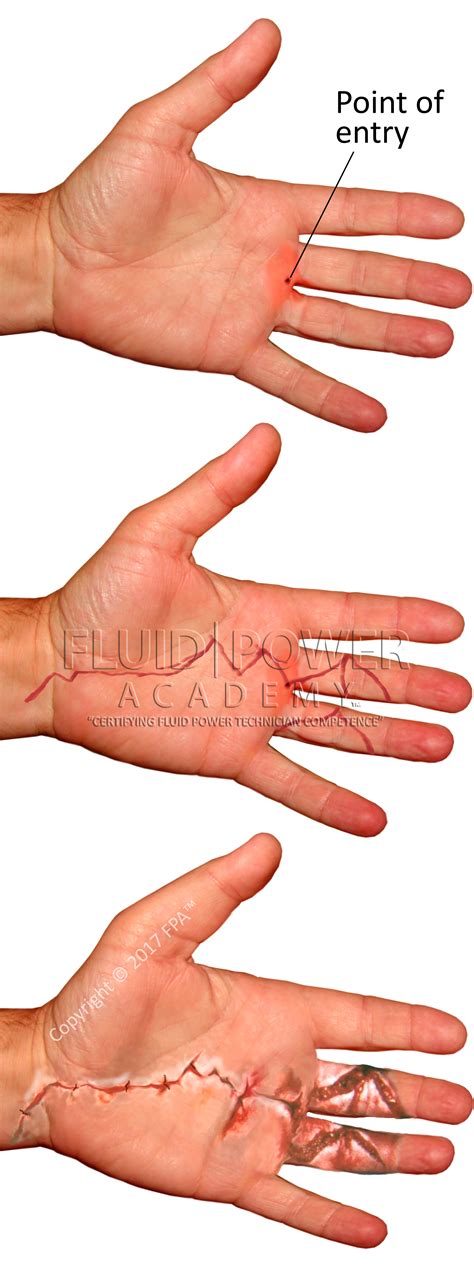 Hydraulic Oil Injection Injuries at Barbara Keeter blog