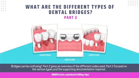 Dental Bridge Ada Code at Jaime Trujillo blog