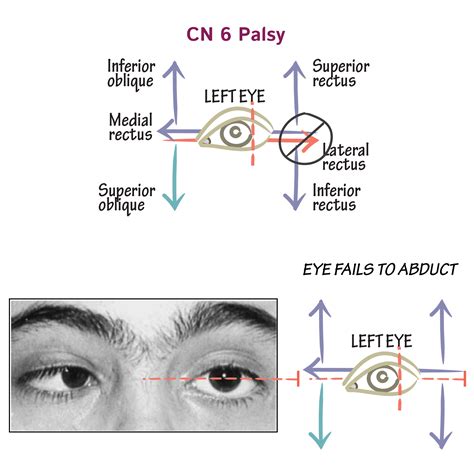 Abducens Nerve Palsy