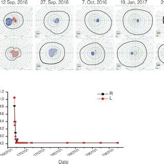 Image result for Visual Fields Red Pin