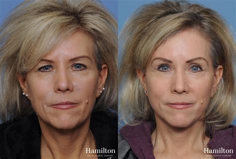 Photo Gallery | Hamilton Facial Plastic Surgery