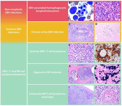 Defining the elusive boundaries of chronic active Epstein-Barr virus infection | Haematologica