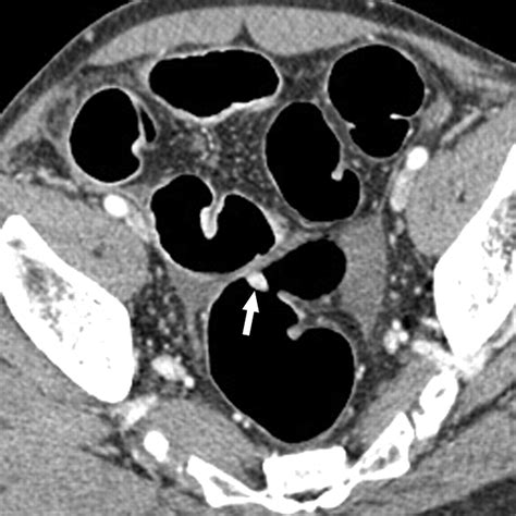 Polyps In Colon Ct Scan at Darla Adkins blog
