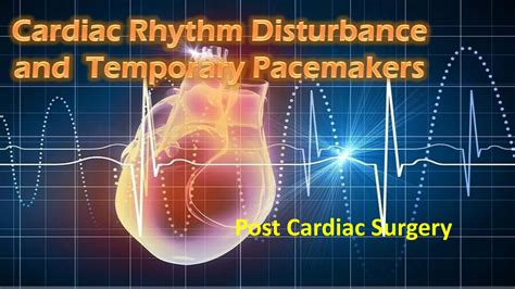 Ventricular Pacemaker Rhythm