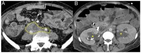 Gastroenterological Manifestations of Immunoglobulin G Subclass 4 ...