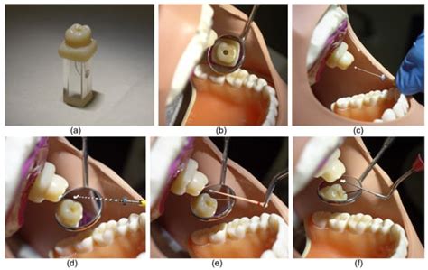 Materials | Special Issue : Dental Materials in Endodontic and Post ...