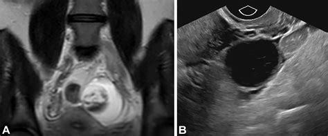 Benign-appearing Incidental Adnexal Cysts at US, CT, and MRI: Putting the ACR, O-RADS, and SRU ...