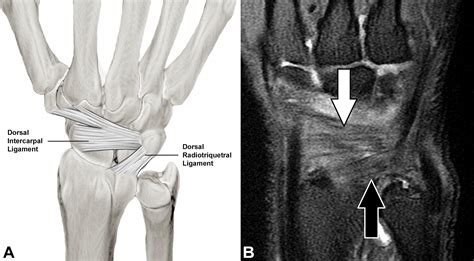Wrist Surgery Ligament Reconstruction at Stuart Witt blog