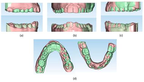 The Power of Customized Clear Aligners in Closing Molar Edentulous ...